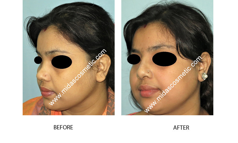 Nose surgery in Bangalore 
