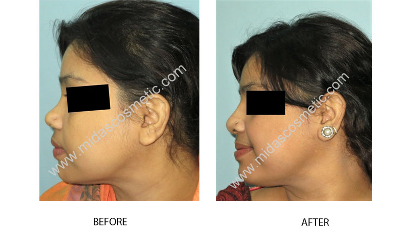 Rhinoplasty surgery cost in Bangalore 