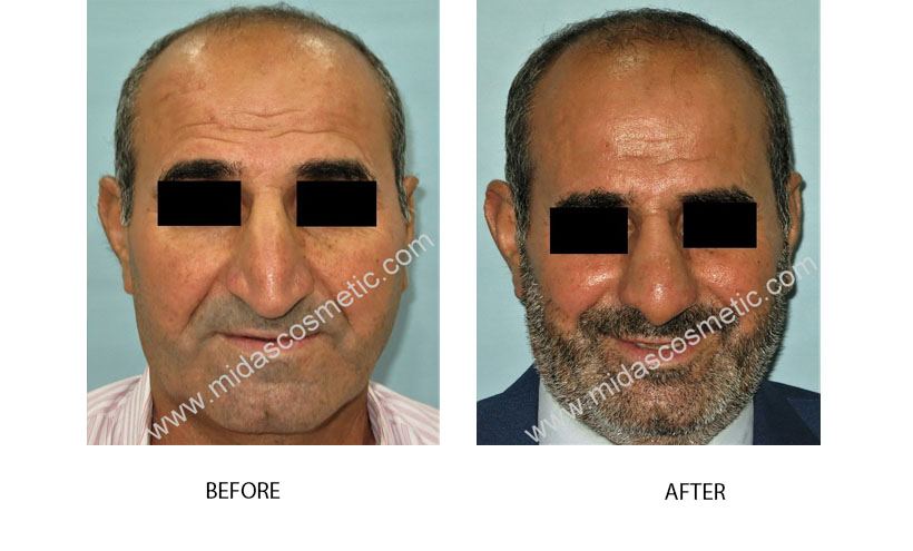 Nose surgery in Bangalore 