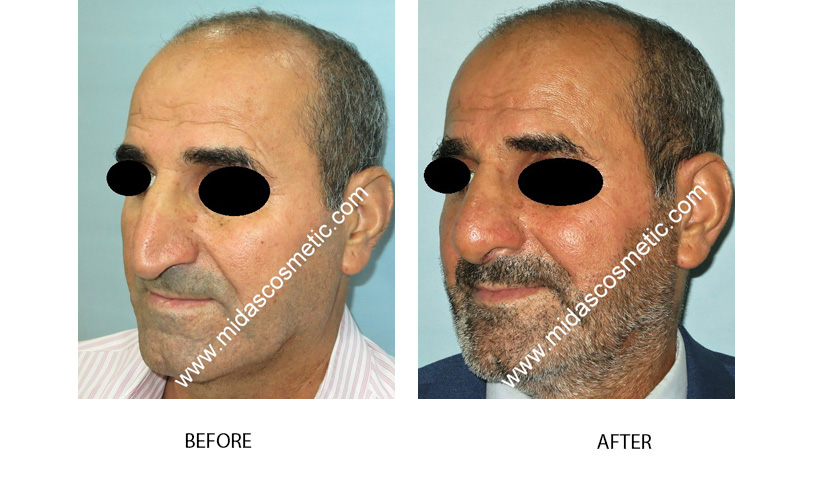 Nose Surgery In Bangalore