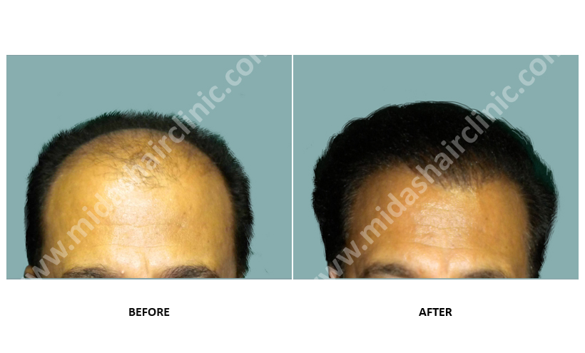 Hair restoration