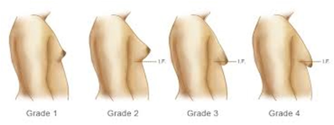 different grades of Gynecomastia