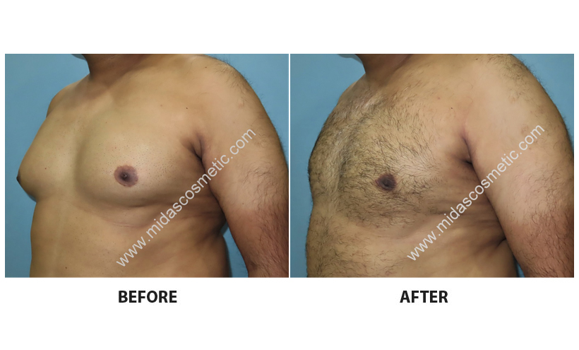 Male breast reduction treatment in Bangalore