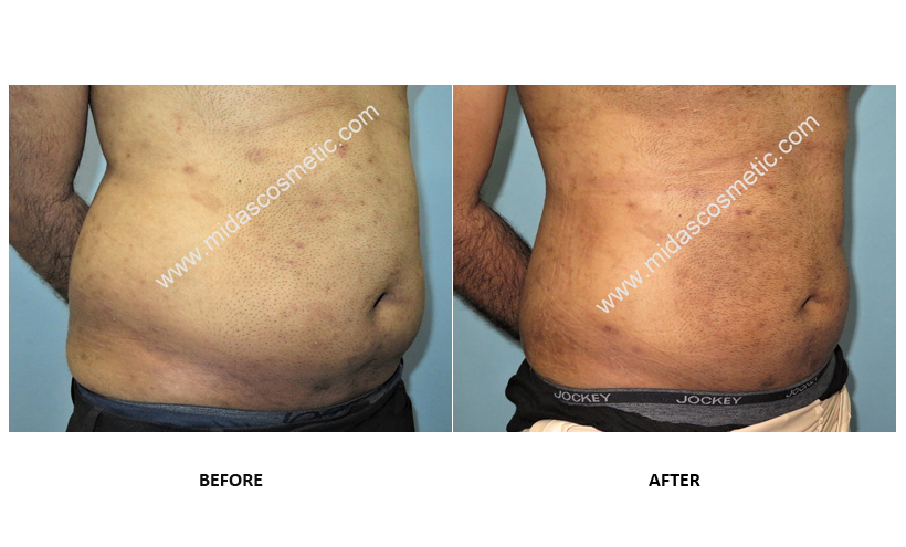Best Liposuction doctor in bangalore