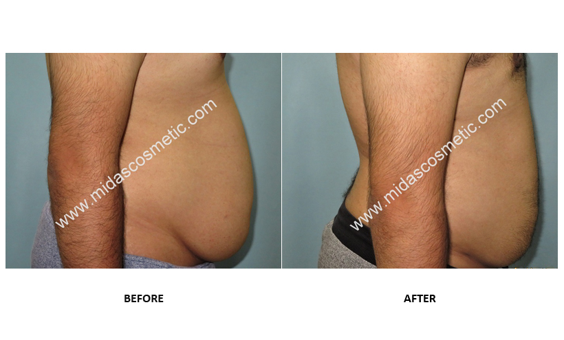 Cost of Liposuction treatment in bangalore
