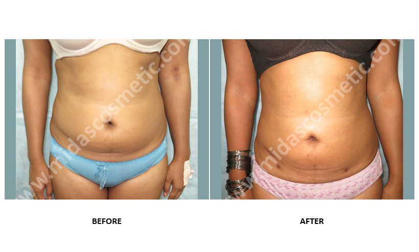 Cost of Liposuction treatment in Bangalore