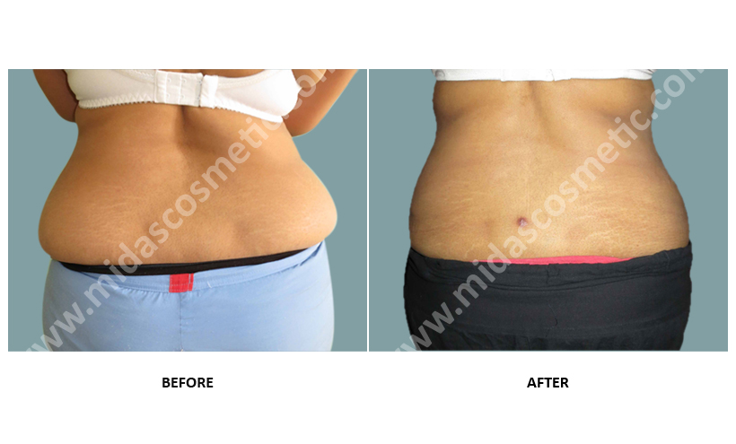 Best Liposuction treatment in bangalore