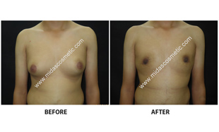 Gynecomastia