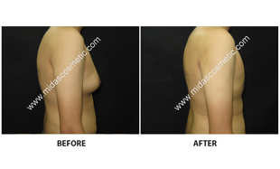 Gynecomastia