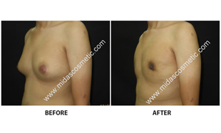 Gynecomastia