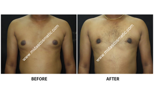 Gynecomastia