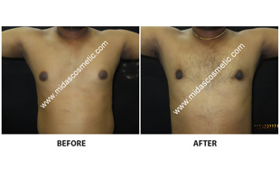 Gynecomastia