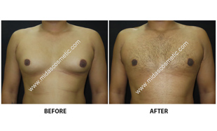 Gynecomastia