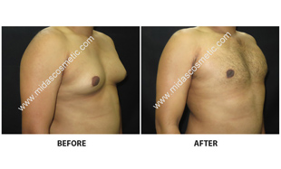 Gynecomastia