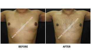 Gynecomastia