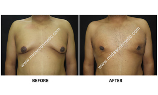 Gynecomastia