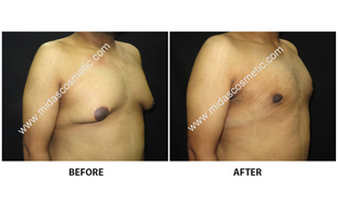 Gynecomastia