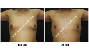 Gynecomastia