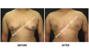 Gynecomastia