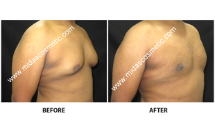 Gynecomastia