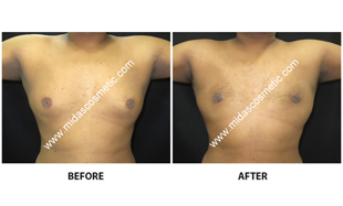 Gynecomastia