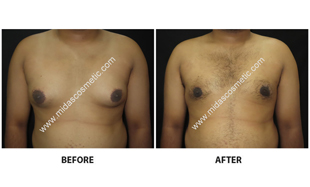 Gynecomastia