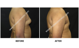 Gynecomastia