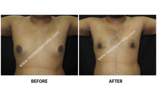 Gynecomastia