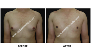 Gynecomastia