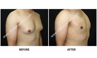Gynecomastia