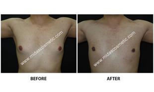 Gynecomastia