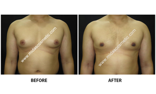 Gynecomastia