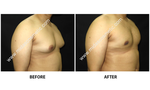 Gynecomastia