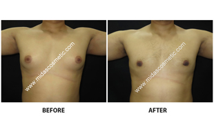 Gynecomastia