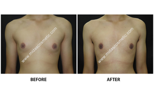 Gynecomastia
