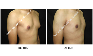 Gynecomastia