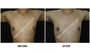 Gynecomastia
