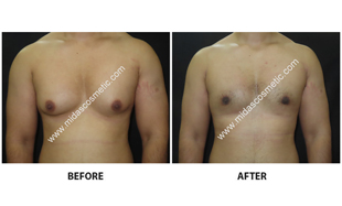 Gynecomastia