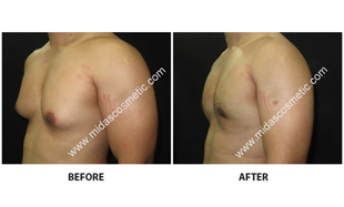 Gynecomastia