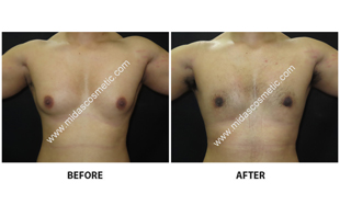 Gynecomastia