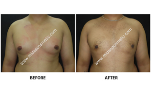 Gynecomastia