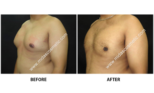 Gynecomastia