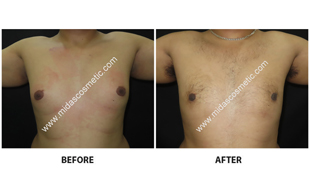 Gynecomastia