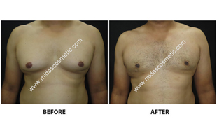 Gynecomastia
