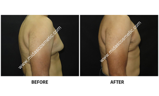 Gynecomastia