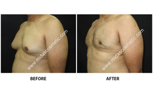 Gynecomastia