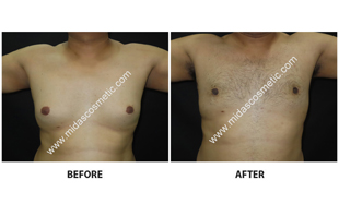 Gynecomastia