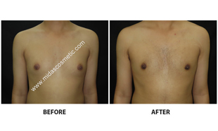 Gynecomastia