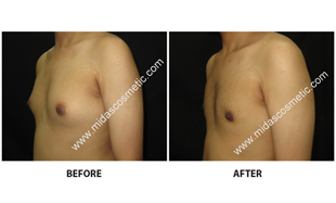 Gynecomastia