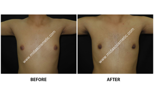 Gynecomastia